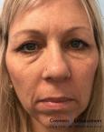 Voluma™ XC : Patient 1 - Before 