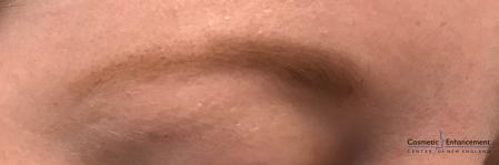 Microblading: Patient 4 - Before Image 2