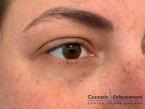 Fillers: Patient 5 - After 