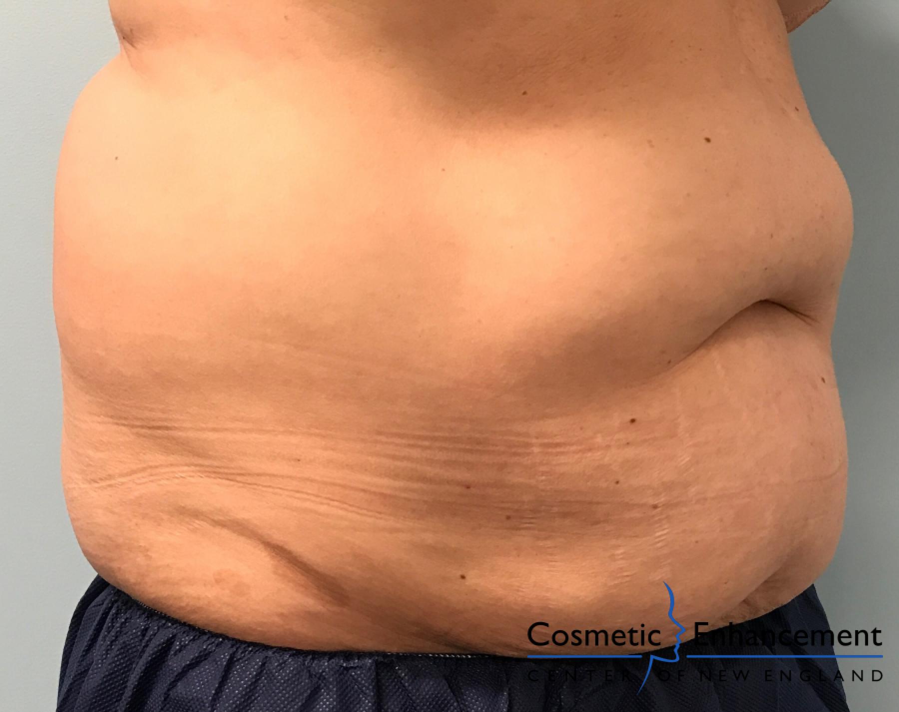 CoolSculpting®: Patient 14 - Before 2