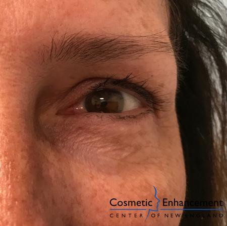 Ultherapy®: Patient 5 - Before and After Image 2