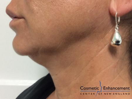 Ultherapy®: Patient 4 - Before Image 1