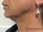 Ultherapy®: Patient 4 - Before 