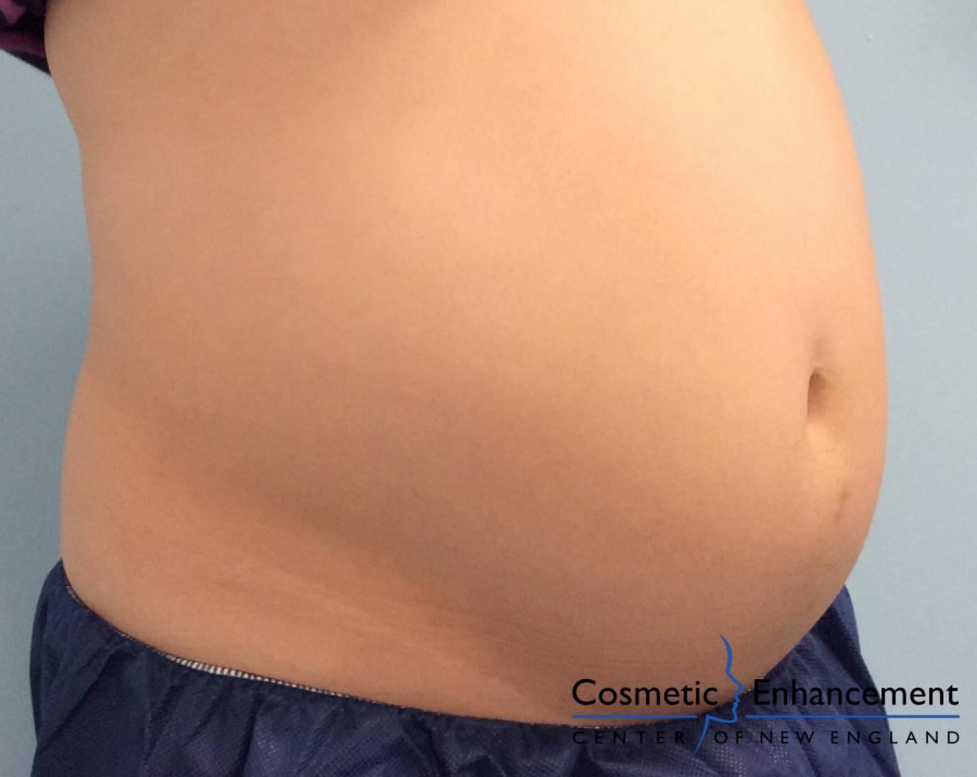 CoolSculpting®: Patient 6 - Before 