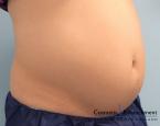 CoolSculpting®: Patient 6 - Before 