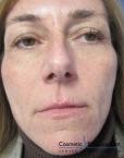 Vampire Facelift: Patient 4 - After Image 