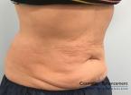CoolSculpting®: Patient 16 - After Image 