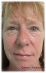 Vampire Facelift: Patient 2 - After Image 