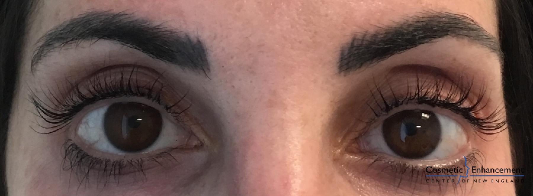Lash Lift And Tint: Patient 3 - After 1