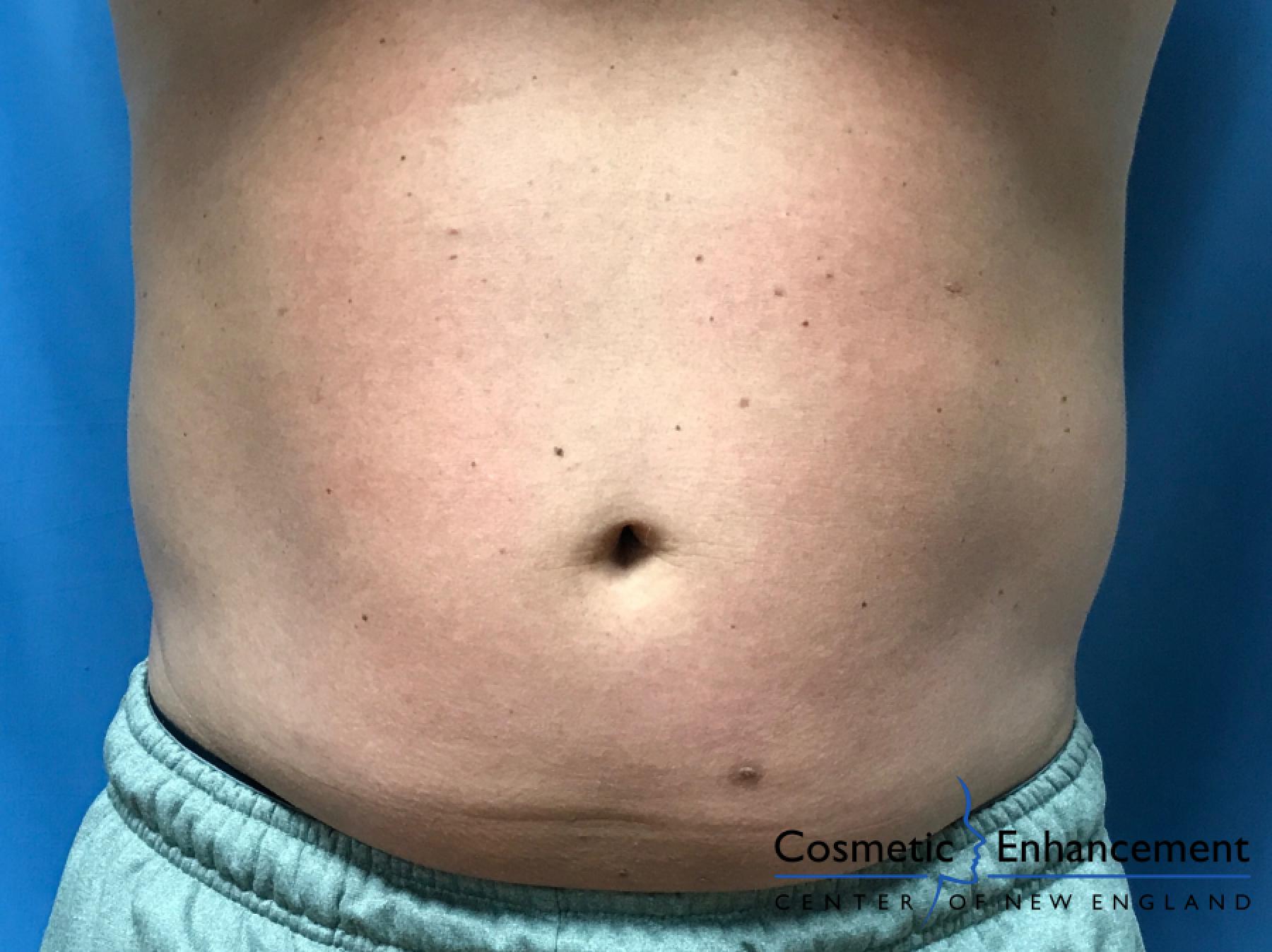 CoolSculpting®: Patient 22 - Before 1