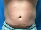 CoolSculpting®: Patient 22 - Before Image 
