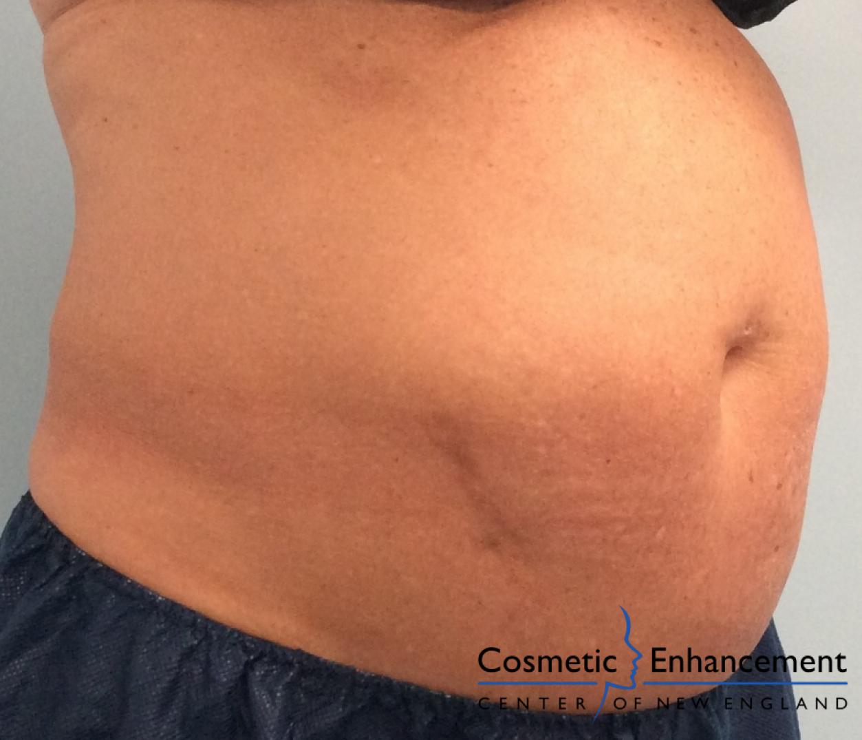 CoolSculpting®: Patient 18 - Before 1