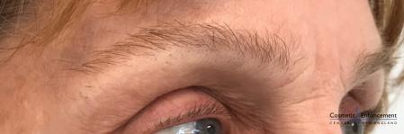 Microblading: Patient 5 - Before Image 2