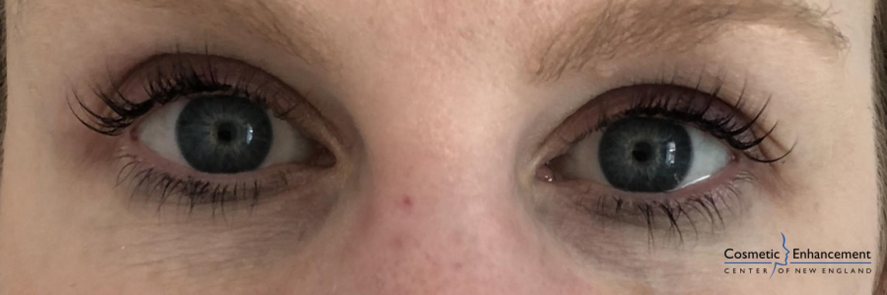 Lash Lift And Tint: Patient 2 - After  