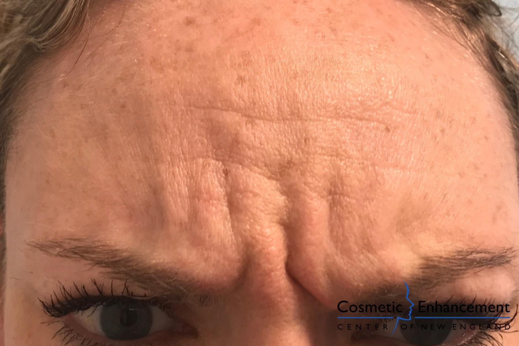 BOTOX® Cosmetic: Patient 3 - After  