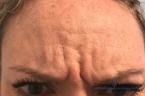 BOTOX® Cosmetic: Patient 3 - Before 