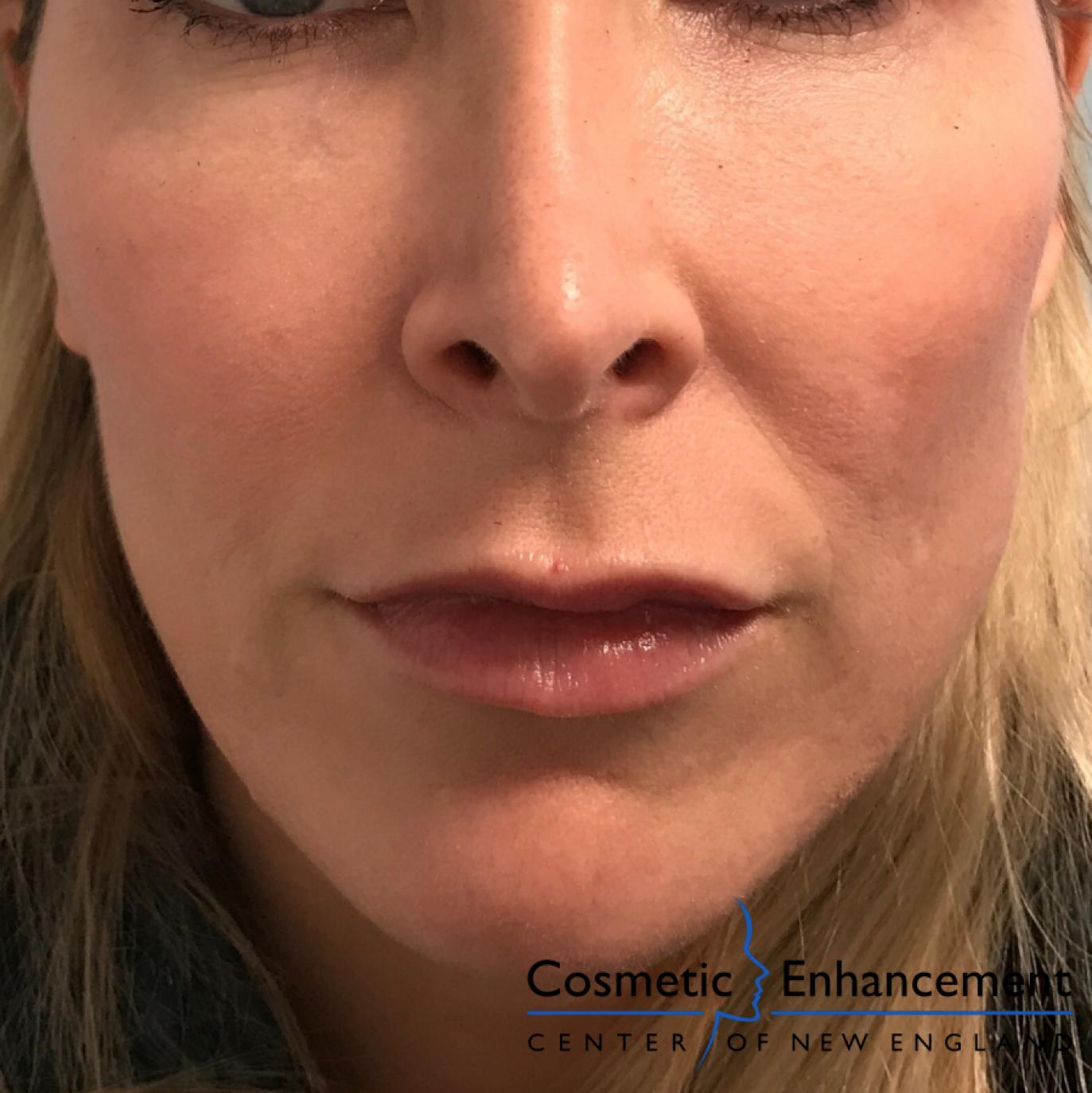 Fillers: Patient 4 - After  