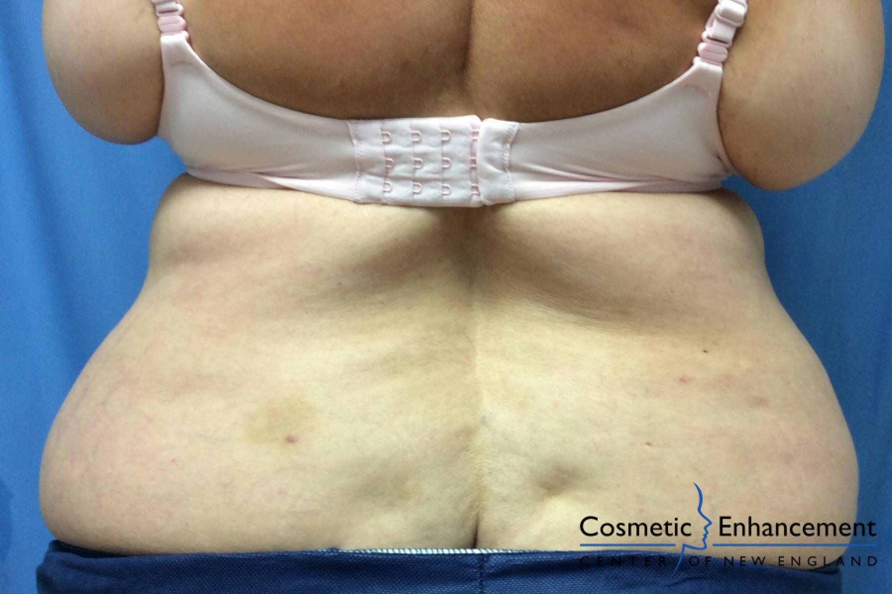 CoolSculpting®: Patient 9 - Before and After 3