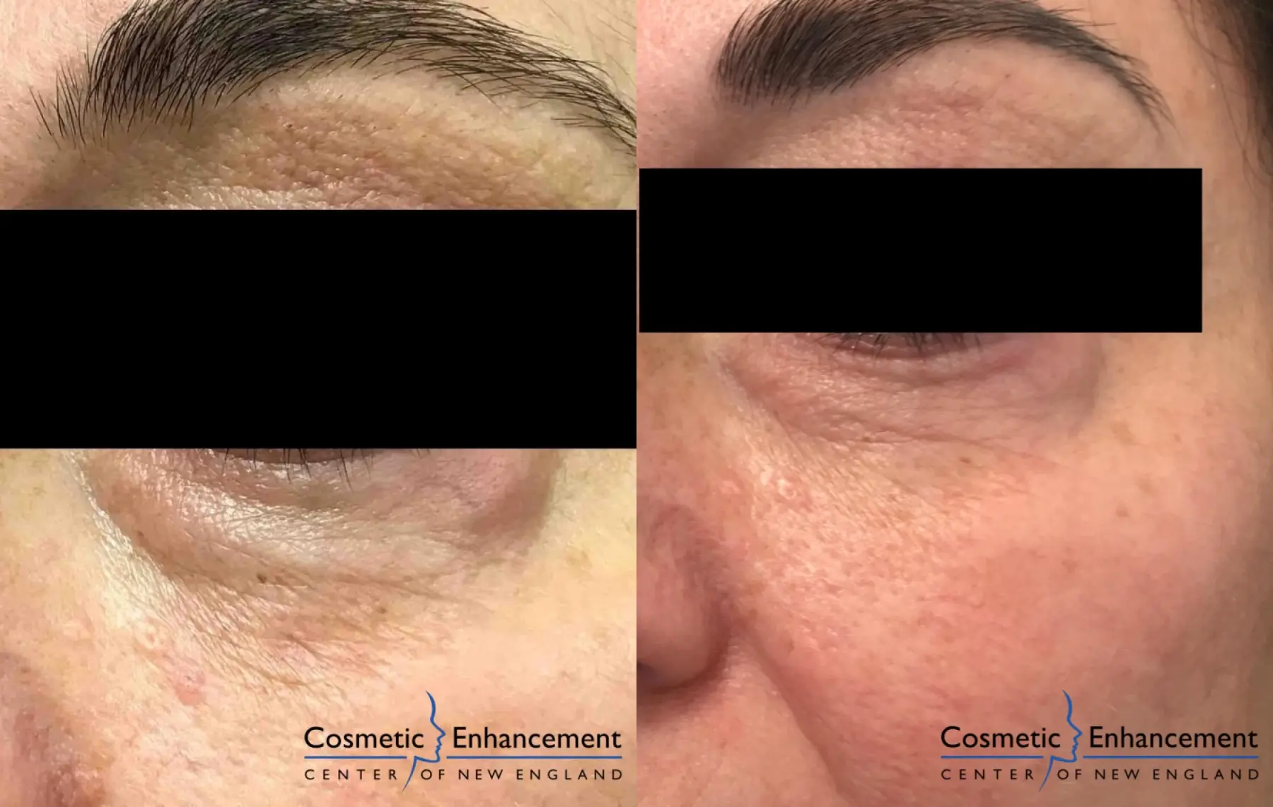 Sculptra: Patient 4 - Before and After 2