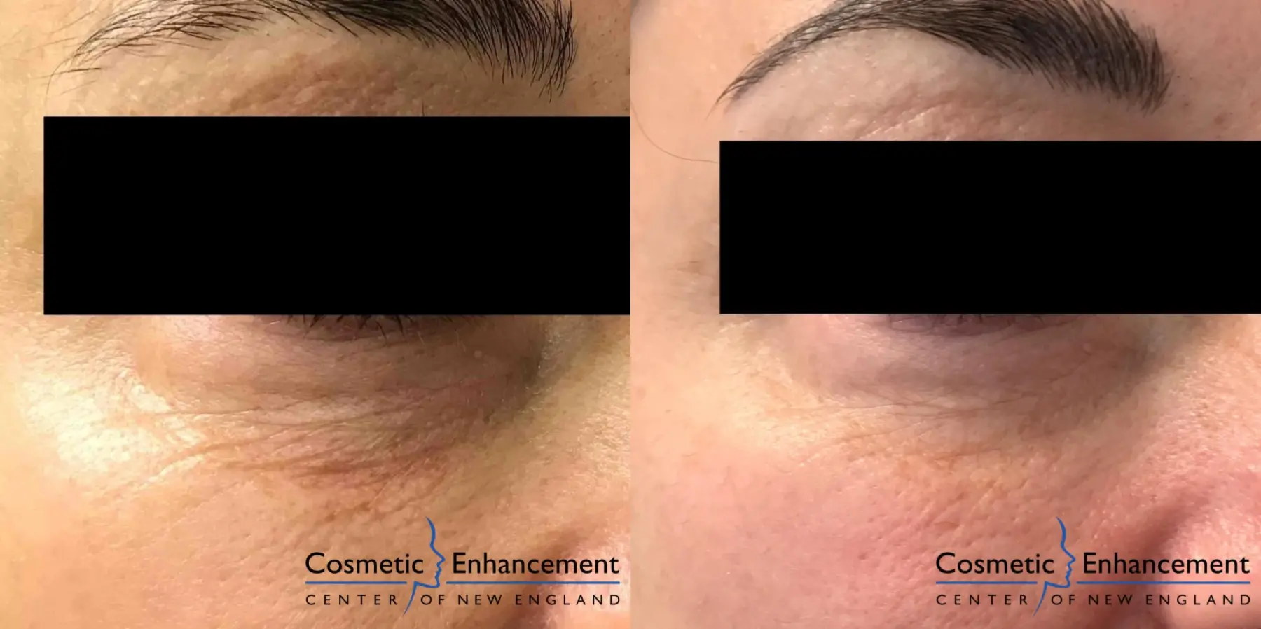 Sculptra: Patient 4 - Before and After 1