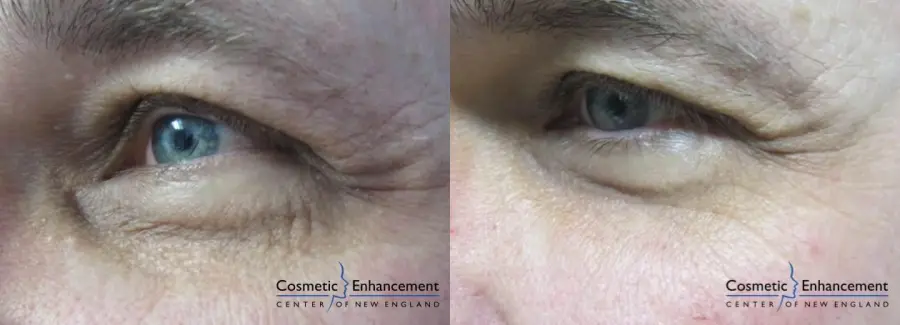 Sculptra: Patient 1 - Before and After  