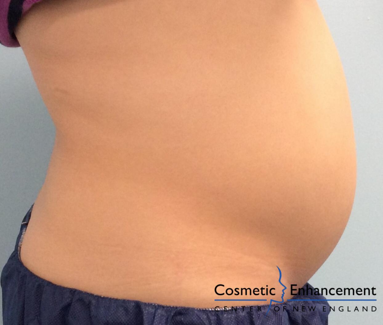 CoolSculpting®: Patient 6 - Before and After 2
