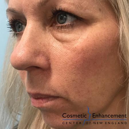 Voluma™ XC: Patient 1 - Before and After Image 2