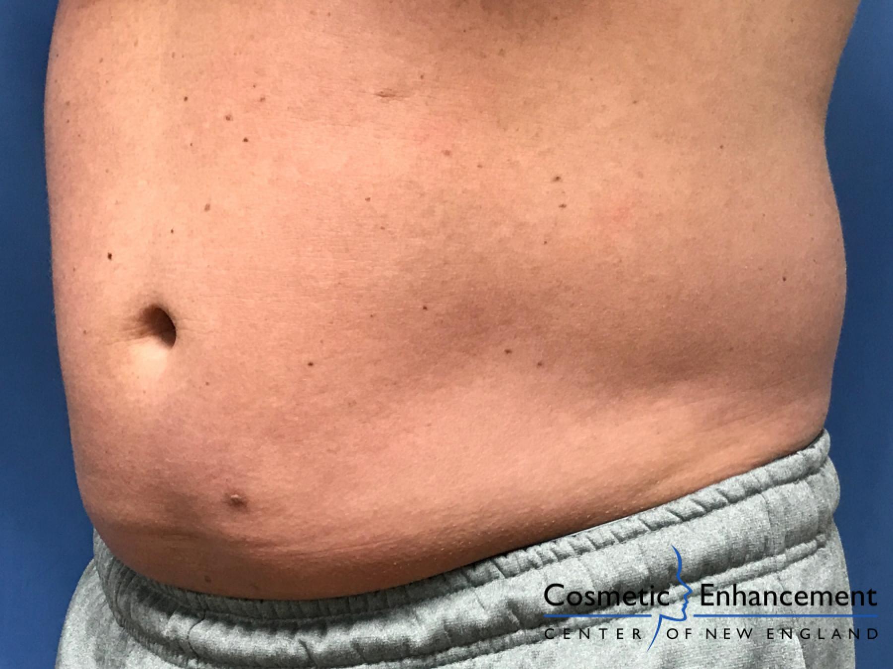 CoolSculpting®: Patient 22 - Before and After 2