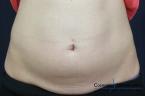 CoolSculpting®: Patient 1 - Before Image 