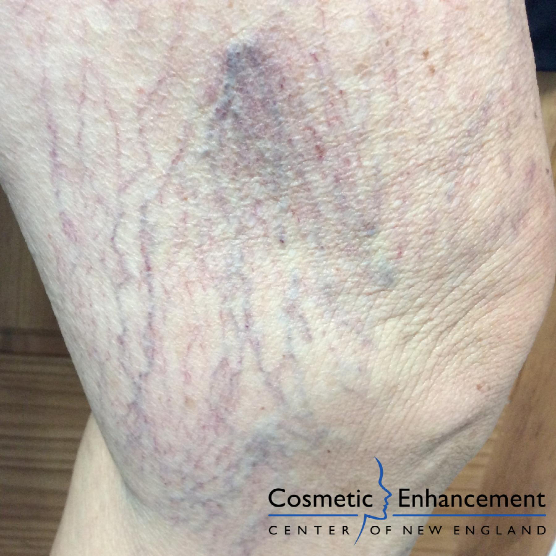 Sclerotherapy: Patient 2 - Before 1