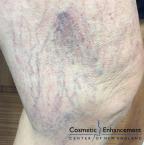 Sclerotherapy: Patient 2 - Before Image 