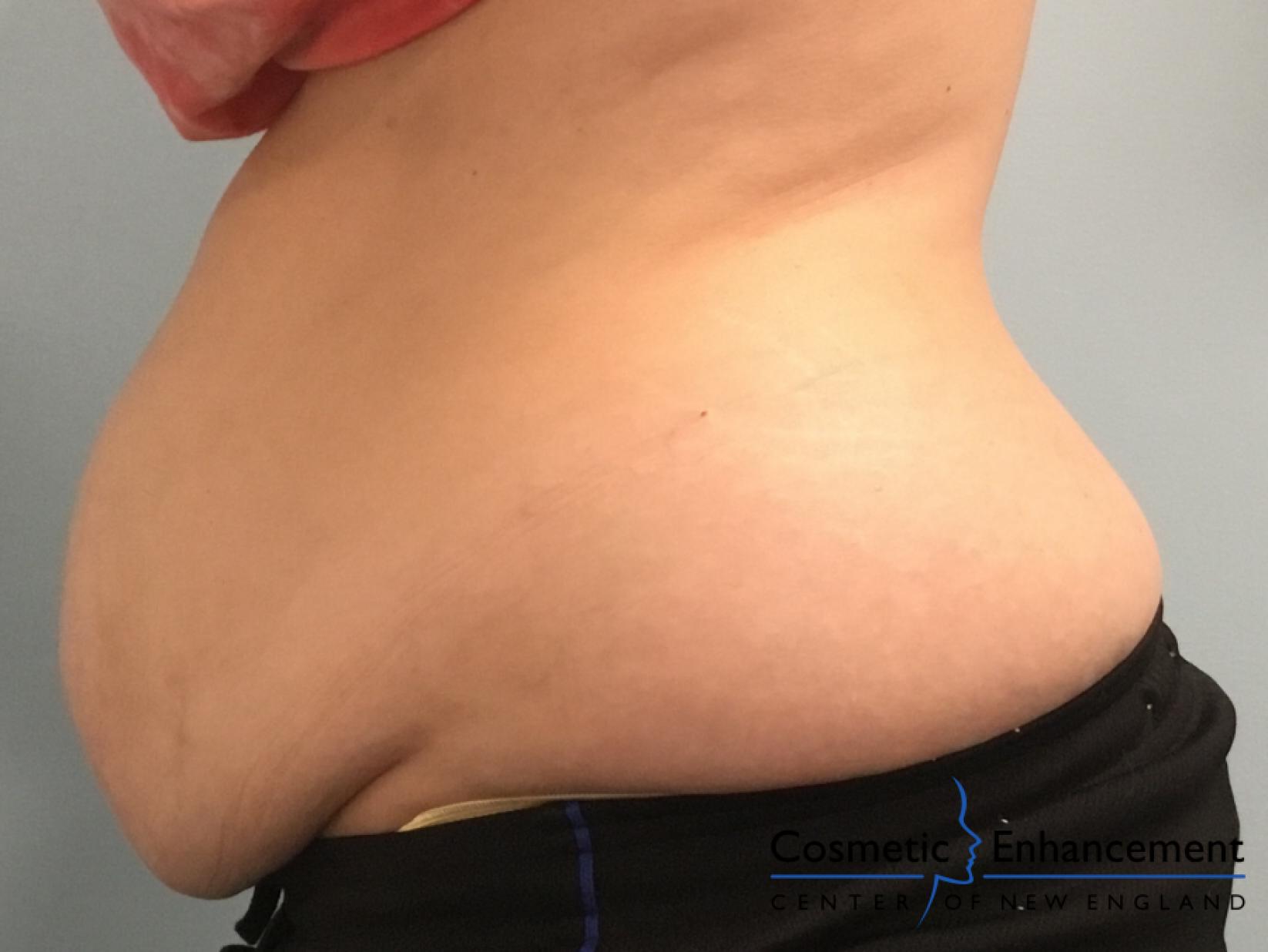 CoolSculpting®: Patient 15 - Before 2