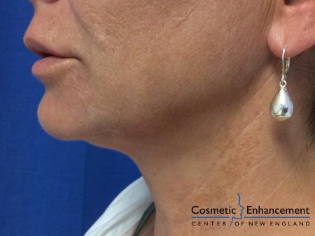 Ultherapy®: Patient 4 - After Image 1