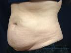 CoolSculpting®: Patient 26 - Before 