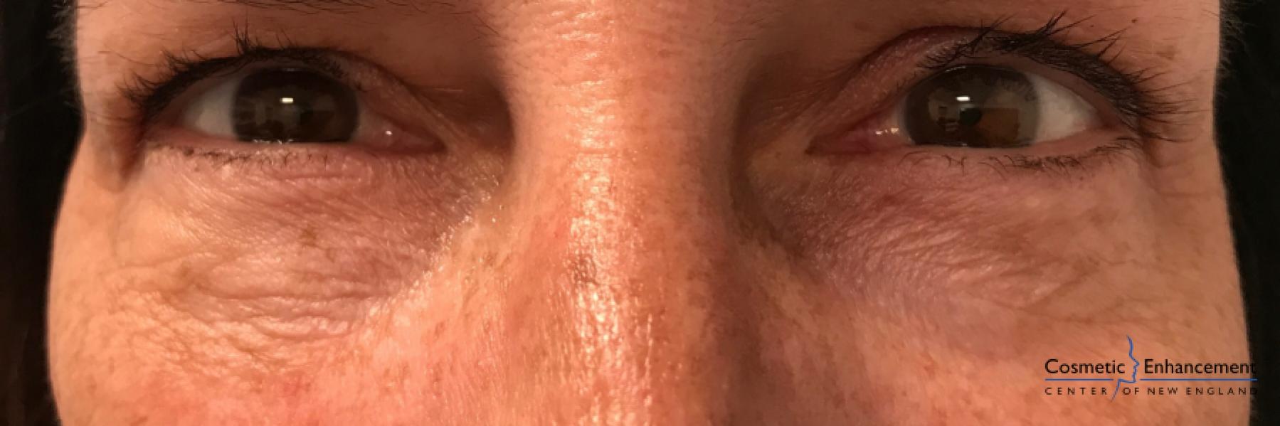 Ultherapy®: Patient 5 - After  