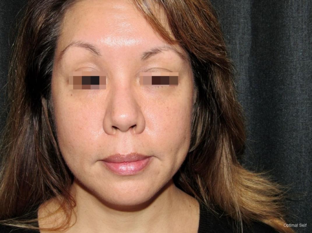 Juvederm: Patient 3 - After  