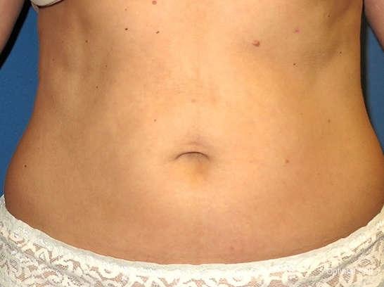 Liposuction: Patient 3 - After  