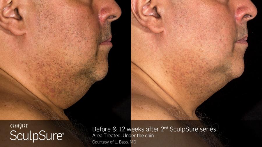 SculpSure™: Patient 2 - Before and After  