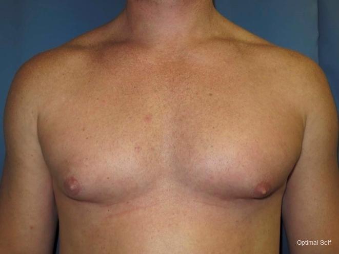 Gynecomastia: Patient 1 - After  