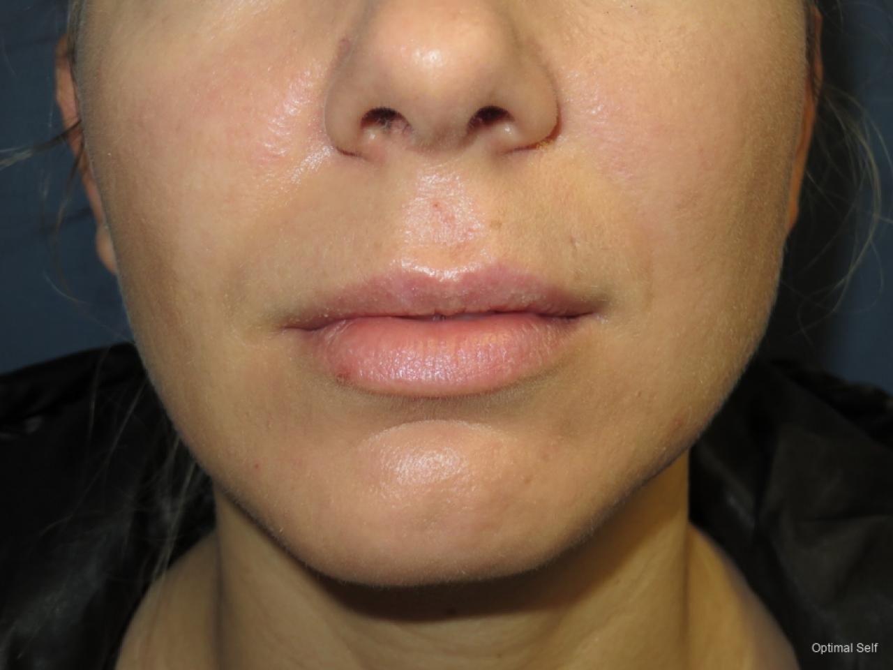 Juvederm: Patient 5 - After  