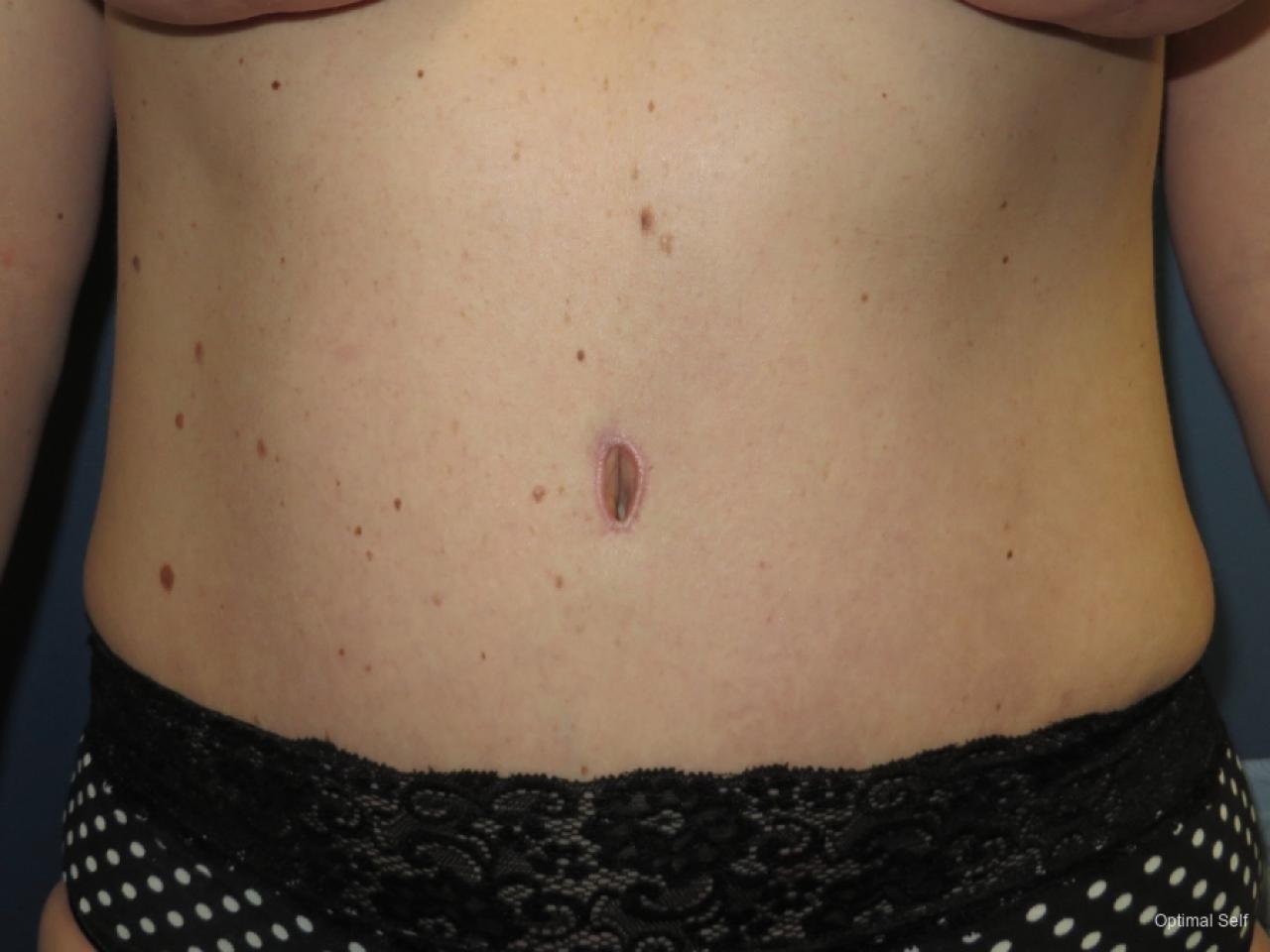 Abdominoplasty: Patient 4 - After  