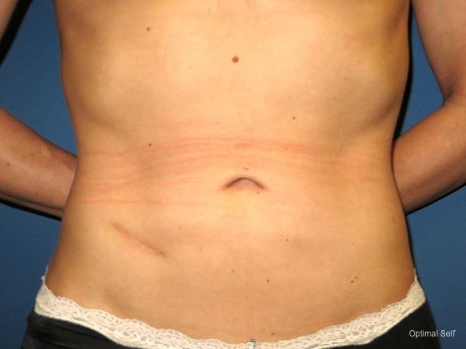 Liposuction: Patient 2 - After  