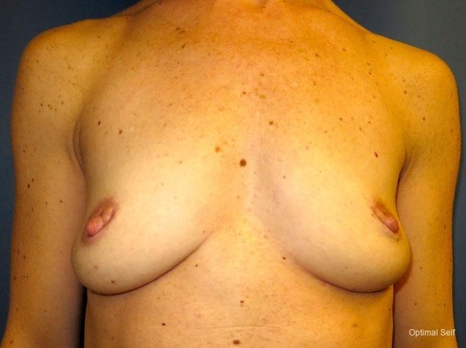 Breast Augmentation: Patient 3 - Before 