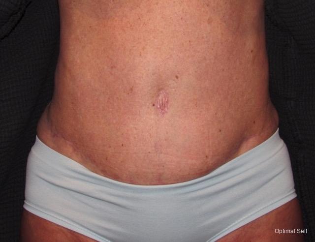 Abdominoplasty: Patient 3 - After  