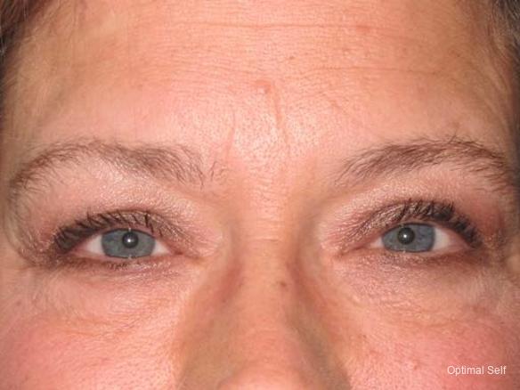 Eyelid Lift: Patient 4 - Before 
