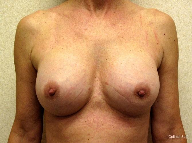 Breast Revision: Patient 2 - After  