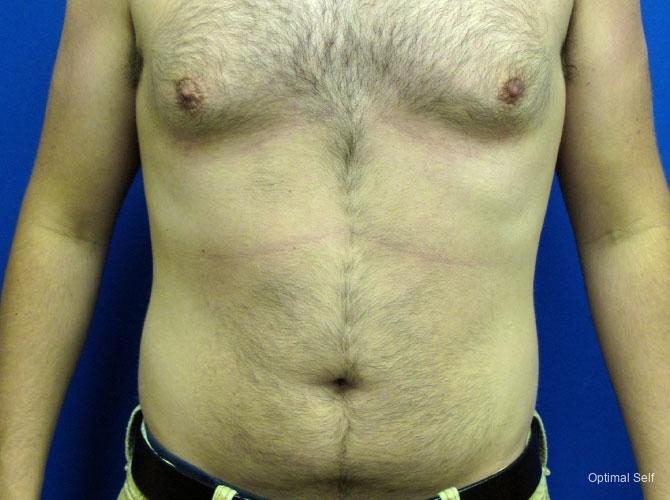 Liposuction: Patient 1 - Before 2