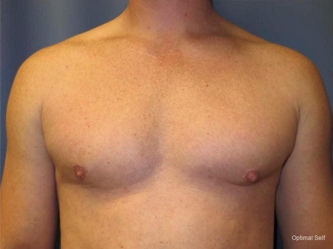 Gynecomastia: Patient 1 - After  