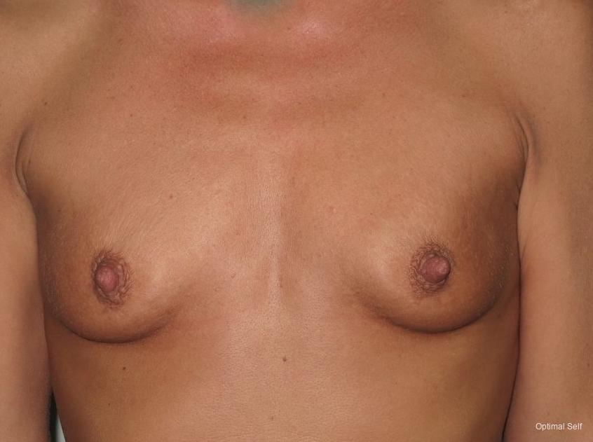 Breast Augmentation: Patient 7 - Before 