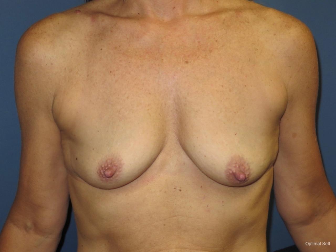 Breast Augmentation: Patient 4 - Before 